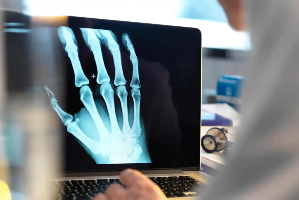 Effect of High Bone Density: Risks and Benefits Explained Effect of High Bone Density: Risks and Benefits Explained effect of high bone density