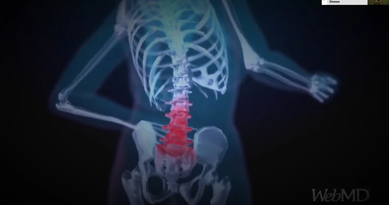 Articles Articles bone health articles