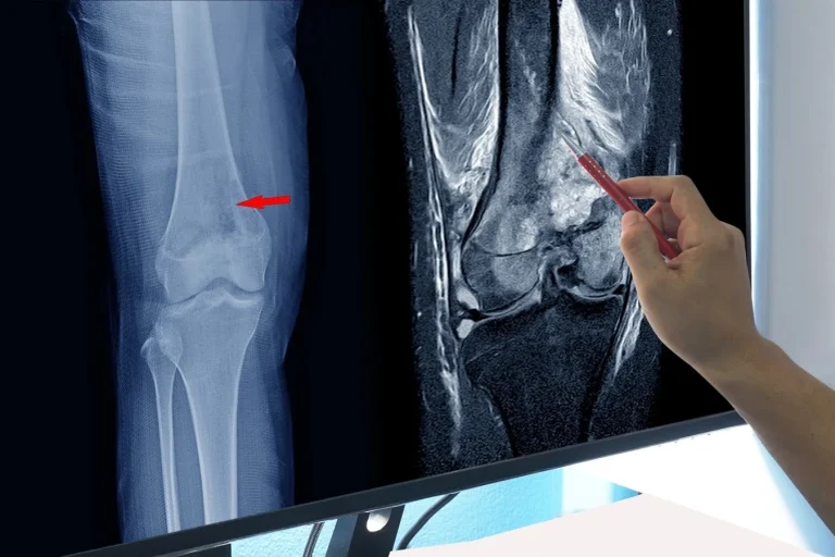 Articles Articles bone health articles