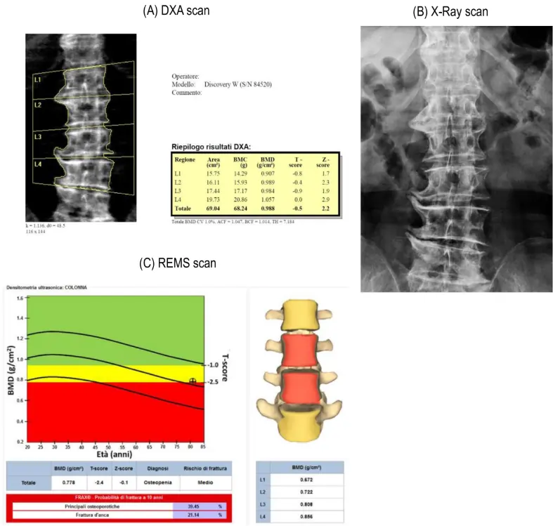 Radiofrequency Echographic Multi - Spectrometry (REMS) for Bone Mineral Density Measurement in Patients with Severe Motor and Intellectual Disabilities (SMID) Radiofrequency Echographic Multi - Spectrometry (REMS) for Bone Mineral Density Measurement in Patients with Severe Motor and Intellectual Disabilities (SMID)