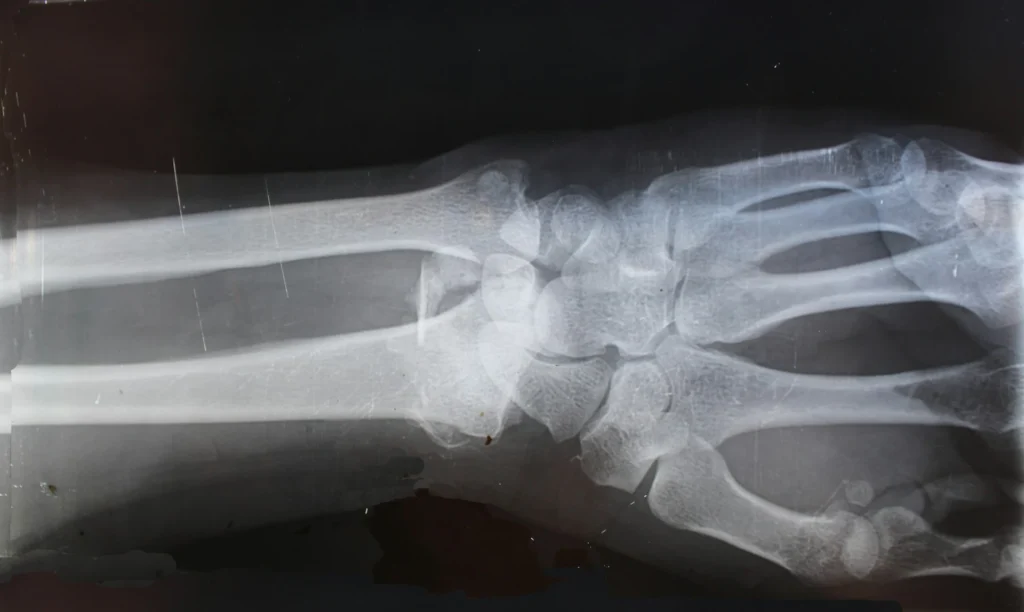 REMS vs DEXA Scan: 7 Reasons Radiation-Free Testing in Los Angeles Is Winning REMS vs DEXA Scan: 7 Reasons Radiation-Free Testing in Los Angeles Is Winning REMS vs DEXA scan
