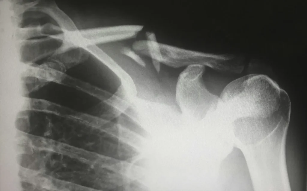 Reduce Fracture Risk: What a Radiation-Free Bone Scan Can Tell You Reduce Fracture Risk by adding a radiation free bone scan session to your routine today.