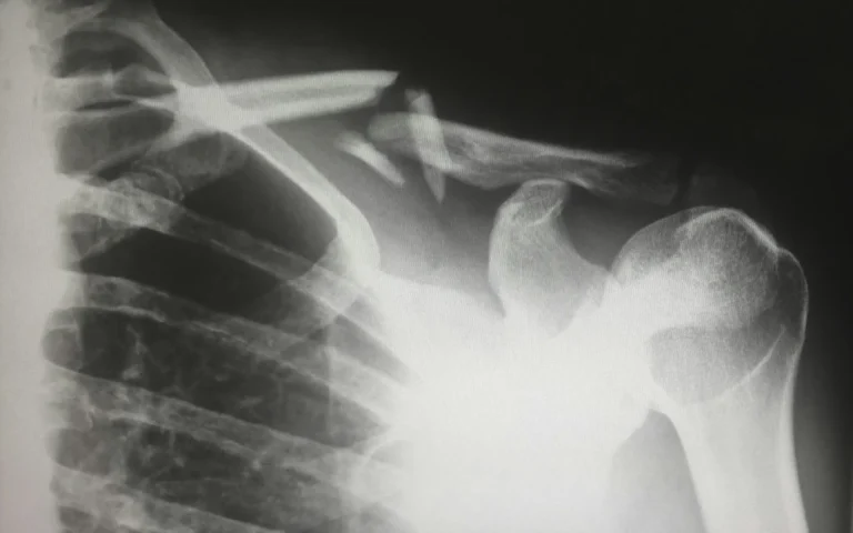 Articles Reduce Fracture Risk by adding a radiation free bone scan session to your routine today.