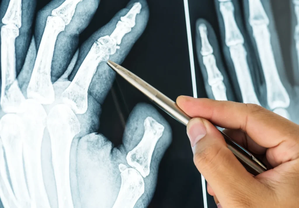 Reduce Fracture Risk: What a Radiation-Free Bone Scan Can Tell You Reduce Fracture Risk: What a Radiation-Free Bone Scan Can Tell You Reduce fracture risk